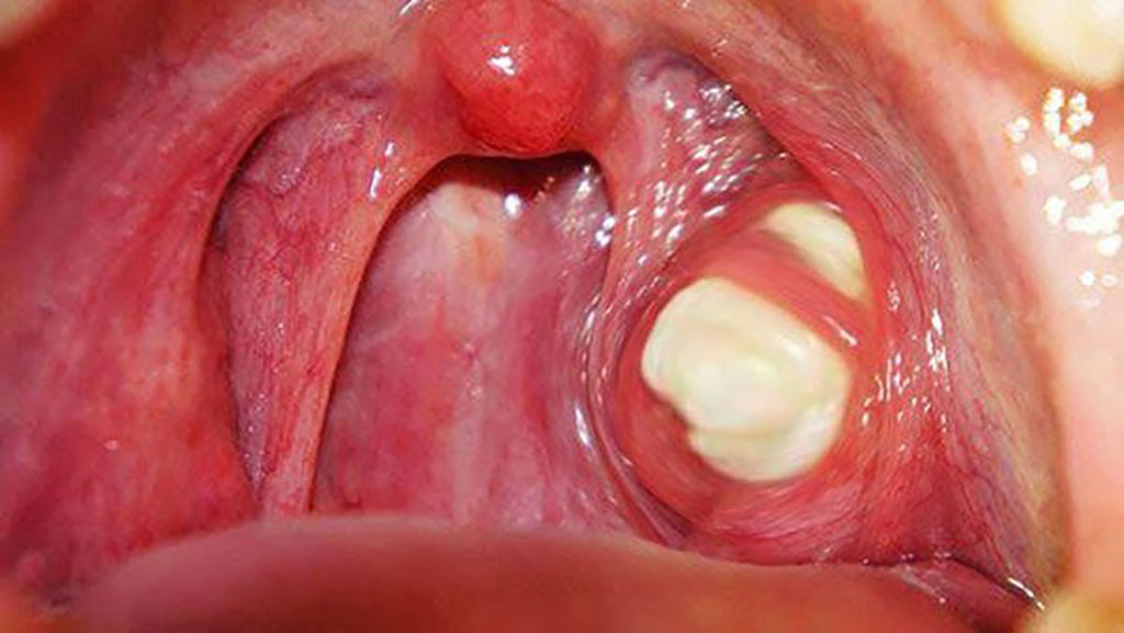 Viêm amidan hốc mủ điều trị bằng răng miệng dạ thảo liên