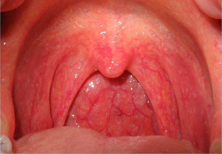 Viêm họng dùng răng miệng dạ thảo liên tại an giang