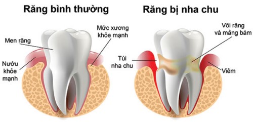 Dùng răng miệng dạ thảo liên trị viêm nha chu