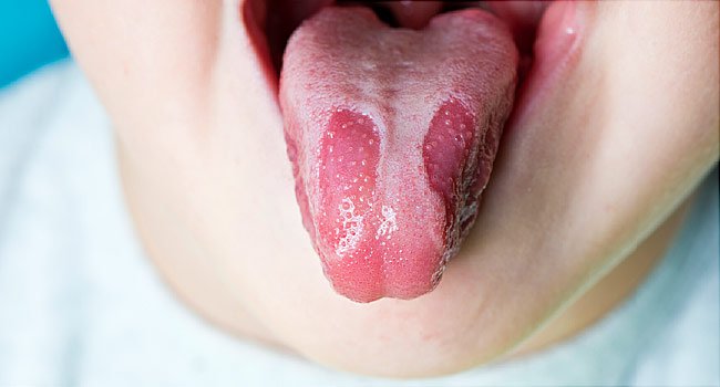 Bệnh nấm lưỡi dùng răng miệng dạ thảo liên trị khỏi hoàn toàn