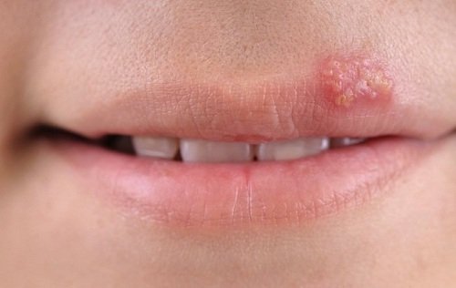 Dùng răng miệng dạ thảo liên trị herpes môi tại nhà