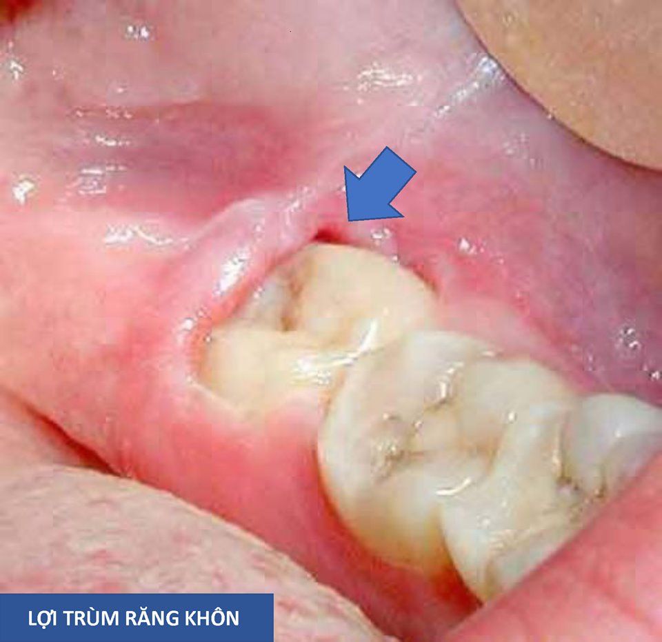 Lợi chùm trị bằng răng miệng dạ thảo liên tại Hà Nội