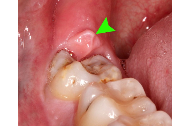 Dùng răng miệng dạ thảo liên trị lợi chùm