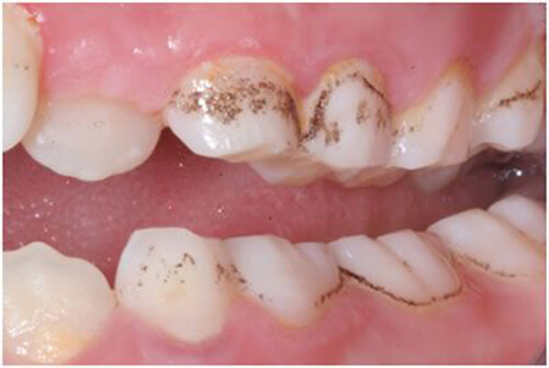 Trắng răng dạ thảo liên trị ố vàng