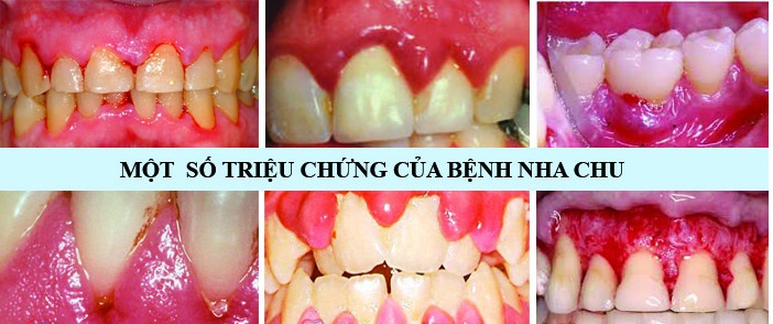 Triệu chứng viêm nha chu cần dùng răng miệng dạ thảo liên