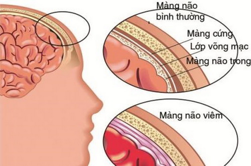 răng miệng dạ thảo liên viêm màng não